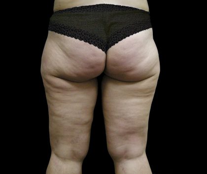Thigh Lift Before & After Patient #3113