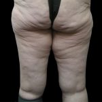 Thigh Lift Before & After Patient #3123