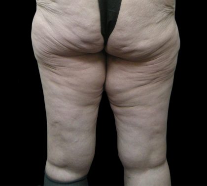 Thigh Lift Before & After Patient #3123