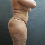 BBL / Brazilian Butt Lift / Gluteal Fat transfer Before & After Patient #1530