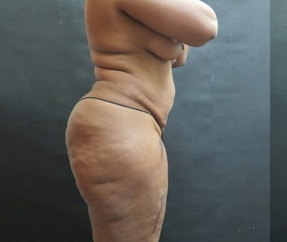 BBL / Brazilian Butt Lift / Gluteal Fat transfer Before & After Patient #1530