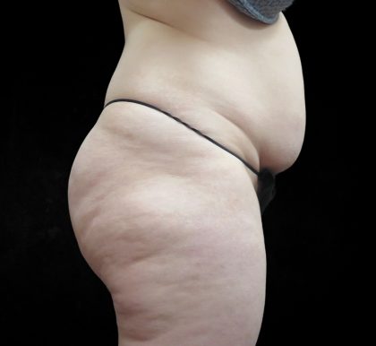 BBL / Brazilian Butt Lift / Gluteal Fat transfer Before & After Patient #1511
