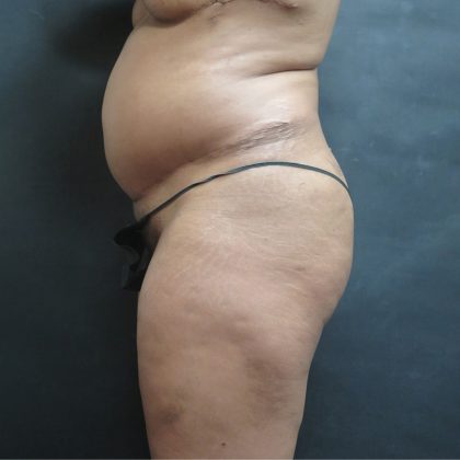 BBL / Brazilian Butt Lift / Gluteal Fat transfer Before & After Patient #1506
