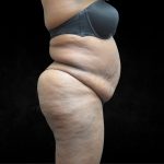 BBL / Brazilian Butt Lift / Gluteal Fat transfer Before & After Patient #1490