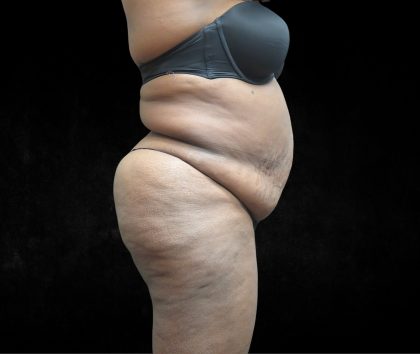 BBL / Brazilian Butt Lift / Gluteal Fat transfer Before & After Patient #1490