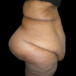Post Weight Loss Before & After Patient #2749