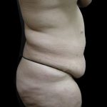 Post Weight Loss Before & After Patient #2791