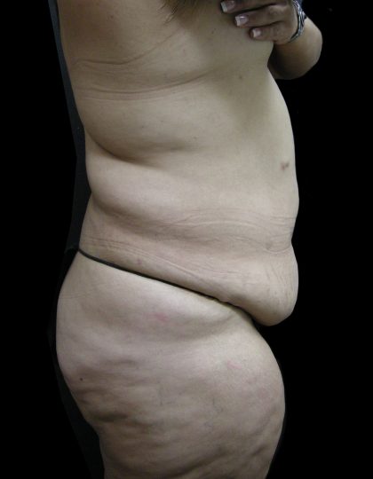 Post Weight Loss Before & After Patient #2791