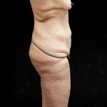 Lower Body Lift Before & After Patient #2262
