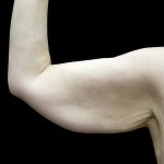 Arm Lift Before & After Patient #897