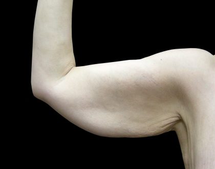 Arm Lift Before & After Patient #897