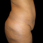 Lower Body Lift Before & After Patient #2327