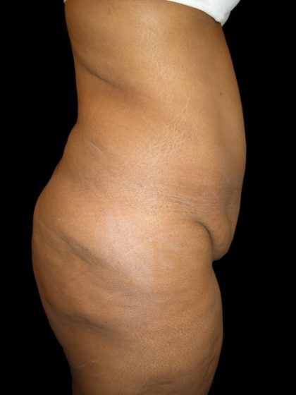 Lower Body Lift Before & After Patient #2327