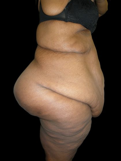 Lower Body Lift Before & After Patient #2294