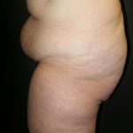 Lower Body Lift Before & After Patient #2285