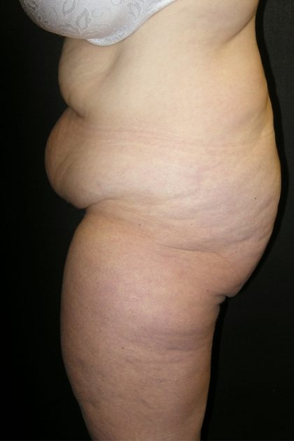 Lower Body Lift Before & After Patient #2285