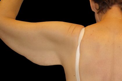 Arm Lift Before & After Patient #913