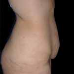 Lower Body Lift Before & After Patient #2278