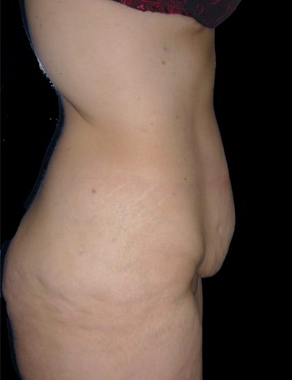 Lower Body Lift Before & After Patient #2278