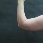 Liposuction Before & After Patient #936