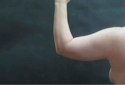 Liposuction Before & After Patient #936