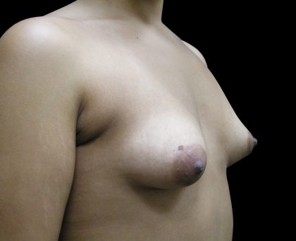 Breast Asymmetry Before & After Patient #965