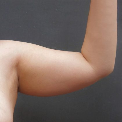 Liposuction Before & After Patient #927