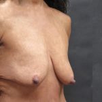 Breast Lift Before & After Patient #1244