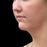 Scarless Facelift and Necklift Before & After Patient #3056