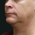 Scarless Facelift and Necklift Before & After Patient #3042