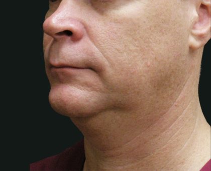 Scarless Facelift and Necklift Before & After Patient #3042