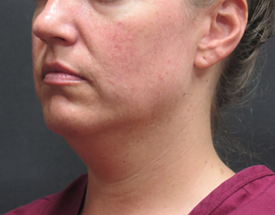 Fat Transfer Before & After Patient #1789