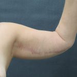 Arm Lift Before & After Patient #888