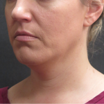 Fat Transfer Before & After Patient #1789