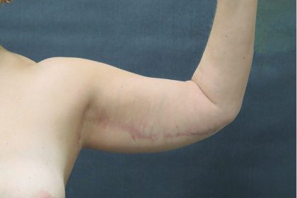 Arm Lift Before & After Patient #888