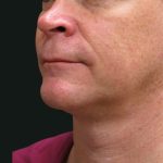 Scarless Facelift and Necklift Before & After Patient #3042