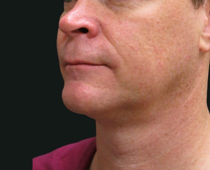Scarless Facelift and Necklift Before & After Patient #3042