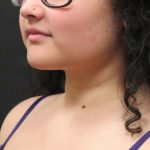 Scarless Facelift and Necklift Before & After Patient #3108