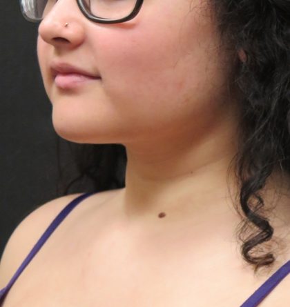 Scarless Facelift and Necklift Before & After Patient #3108