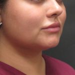 Scarless Facelift and Necklift Before & After Patient #3028