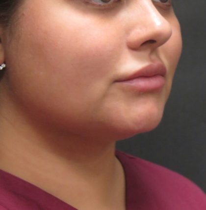 Scarless Facelift and Necklift Before & After Patient #3028