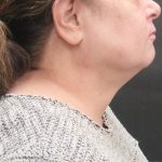 Scarless Facelift and Necklift Before & After Patient #3049
