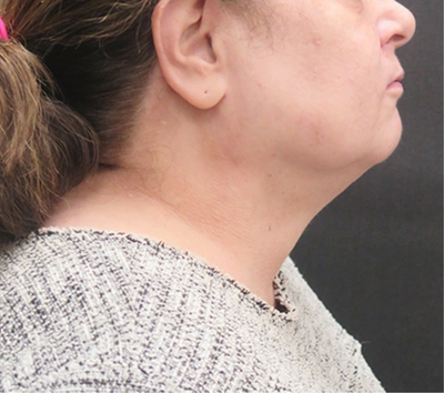 Scarless Facelift and Necklift Before & After Patient #3049
