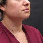 Scarless Facelift and Necklift Before & After Patient #3067