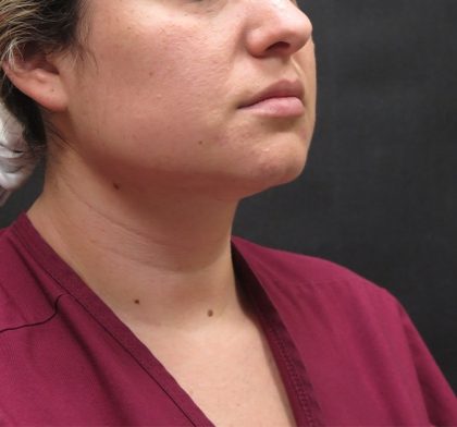 Scarless Facelift and Necklift Before & After Patient #3067