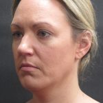 Scarless Facelift and Necklift Before & After Patient #3101