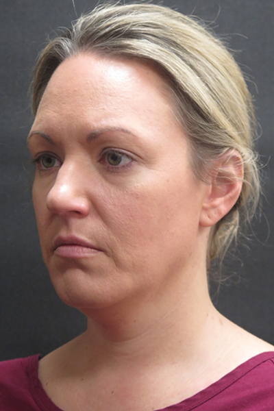 Scarless Facelift and Necklift Before & After Patient #3101