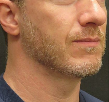 Scarless Facelift and Necklift Before & After Patient #3074