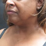 Scarless Facelift and Necklift Before & After Patient #1910