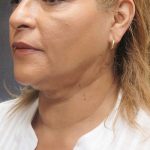 Scarless Facelift and Necklift Before & After Patient #3081